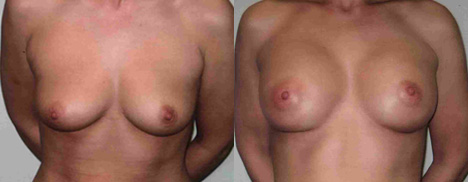 34 years old- 270 cc Gel cohesive silicone implants below the muscle, inframmamary - 34 B to 34 C